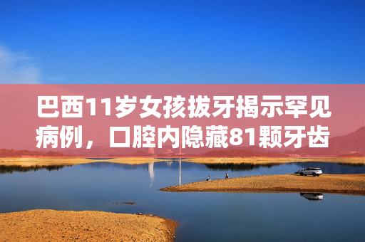 巴西11岁女孩拔牙揭示罕见病例，口腔内隐藏81颗牙齿